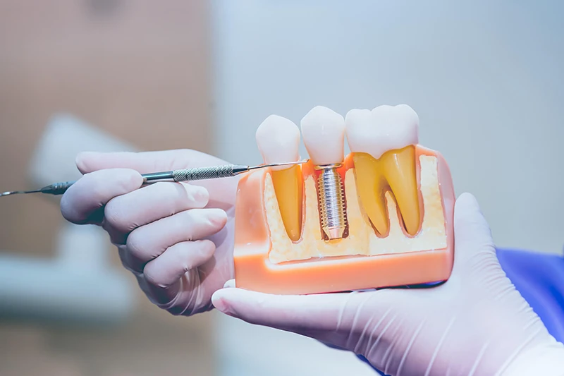 Model implantu stomatologicznego